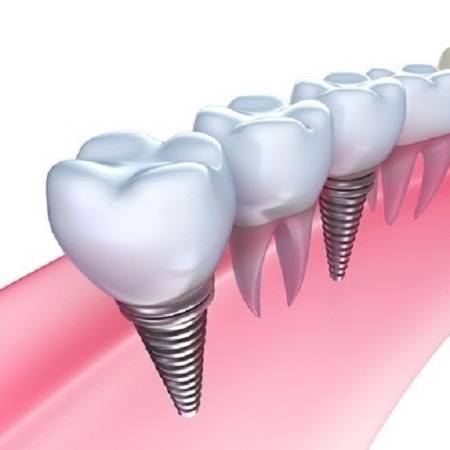 gevolg zag oplichter Implantaten en algehele gezondheid; bij wie wel en wie niet? - dental INFO