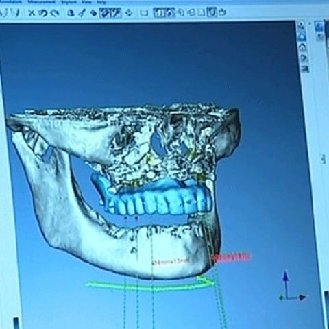 Patiënten Radboudumc tevreden over 3D-kunstgebit