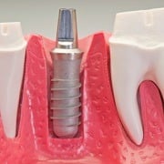 Dental Implant Model