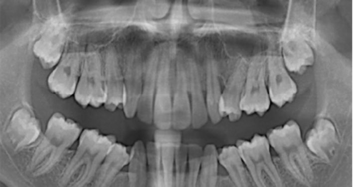 M3 en apexresectie indicatiestelling en behandeling
