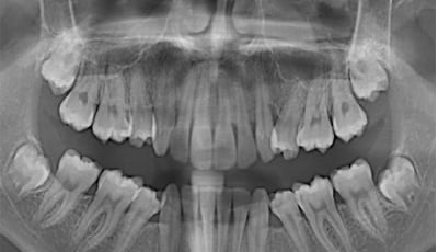 M3 en apexresectie indicatiestelling en behandeling