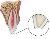 fractuurtype 1