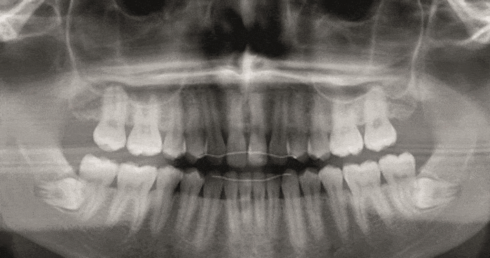 Endodontische behandeling: 2d of 3d?
