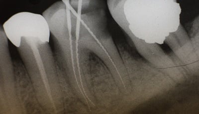 pijnbestrijding-endodontie