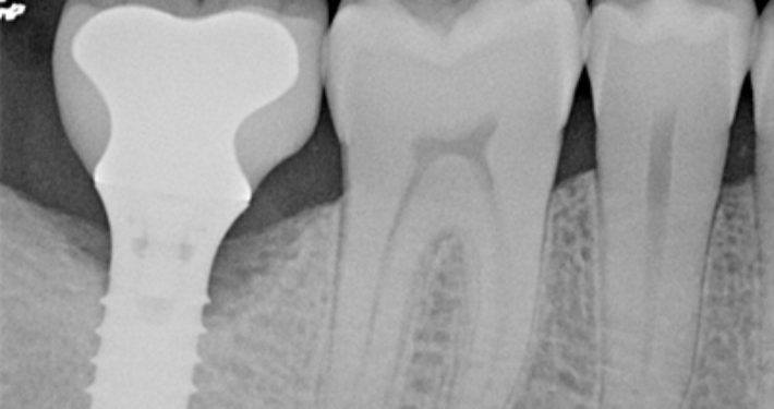 Peri-implantitis: hoe behandelen én voorkomen?