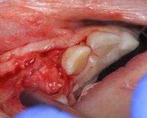 Casus: Radiolucentie regio 12 op orthopantomogram van 7-jarige jongen