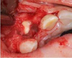 Casus: Radiolucentie regio 12 op orthopantomogram van 7-jarige jongen