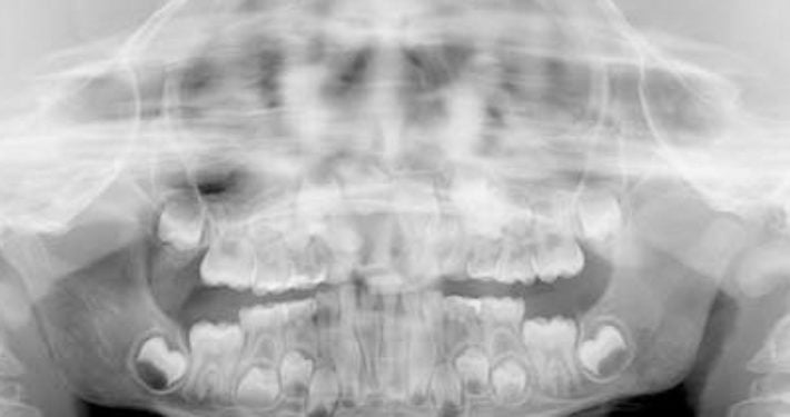 Casus: Radiolucentie regio 12 op orthopantomogram van 7-jarige jongen