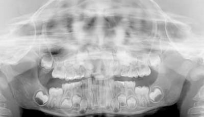 Casus: Radiolucentie regio 12 op orthopantomogram van 7-jarige jongen