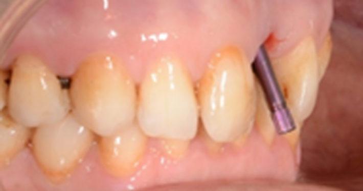 Forma MTX abutment