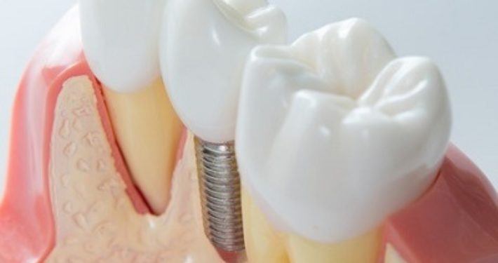 Implantaten