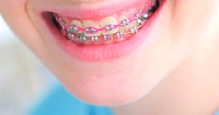 orthodontische