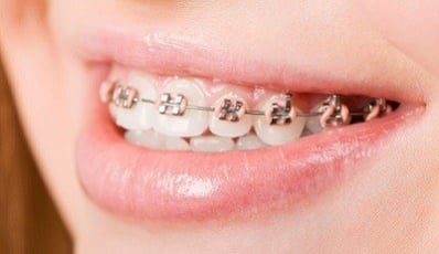 Orthodontische op jonge leeftijd: wacht op spontaan herstel onderzoekers - dental INFO