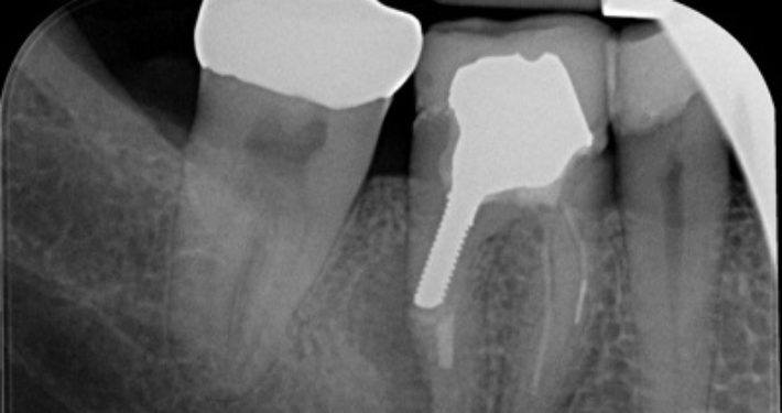 endodontische