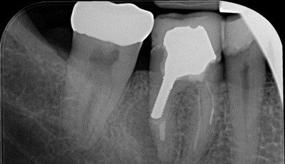 endodontische