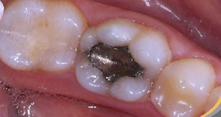 amalgaamvulling