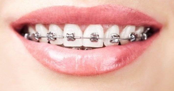 niet-zelf-orthodontie