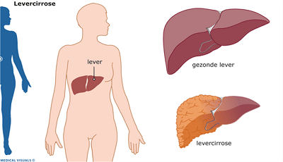 levercirrose