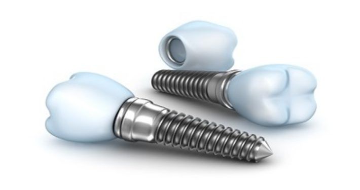 Implantaten
