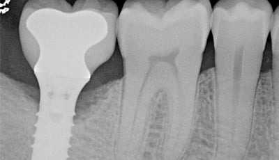 peri-implantitis