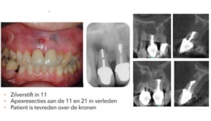 De gecompromitteerde voortand - Casus 2