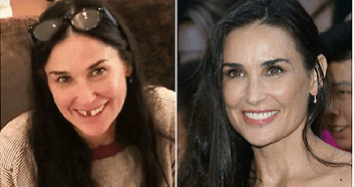 Demi moore tandverlies door stress