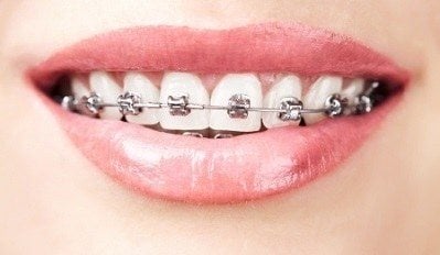 orthodontist - Beugel