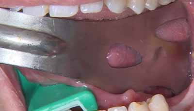 Bot lamina techniek voor de alveolaire ridge aangroei in de kaak