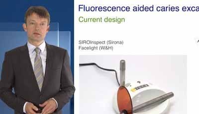 Fluorescence Aided Caries Excavation (FACE) – Deel 3: Klinische toepassing met behulp van SIROInspect en opties voor diepe cariës