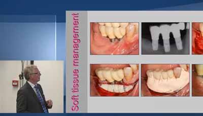 Peri-implantitis – Deel 6: Chirurgische behandeling I