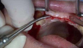 Splitsing alveolaire botrand met plaatsing implantaten