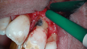 Casus endodontologie 