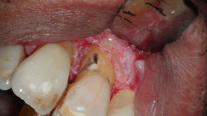 Casus endodontologie 