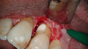 Casus endodontologie 