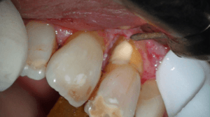 Casus endodontologie 