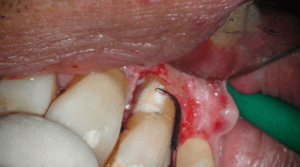 Casus endodontologie 