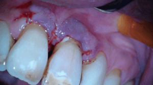 Casus endodontologie 