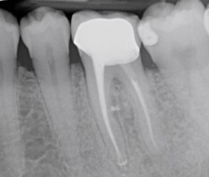 Casus endodontologie 