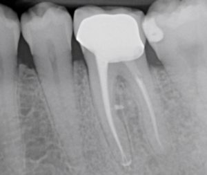 Casus endodontologie 