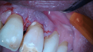 Casus endodontologie 