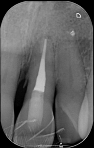 Casus endodontologie 