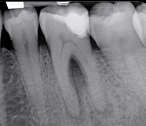 Casus endodontologie 