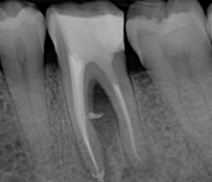 Casus endodontologie 