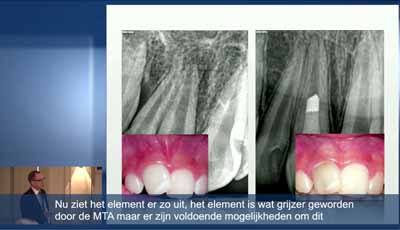 Het moderne endodontische behandelingsconcept: Introductie (Nederlands ondertiteld)