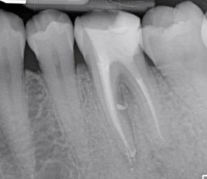 Casus endodontologie 