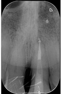 Casus endodontologie 