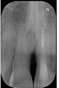 Casus endodontologie 