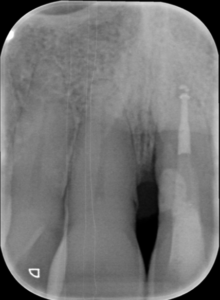 Casus endodontologie 