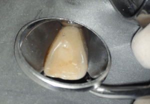 Casus endodontologie 