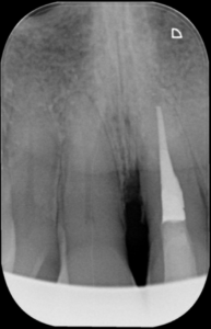 casus endodontologie 